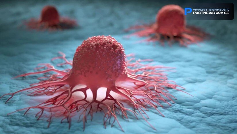 საშვილოსნოს ყელის კიბოს „შენიღბული“ სიმპტომი, რომელიც უყურადღებოდ არ უნდა დარჩეს - ექიმების გაფრთხილება